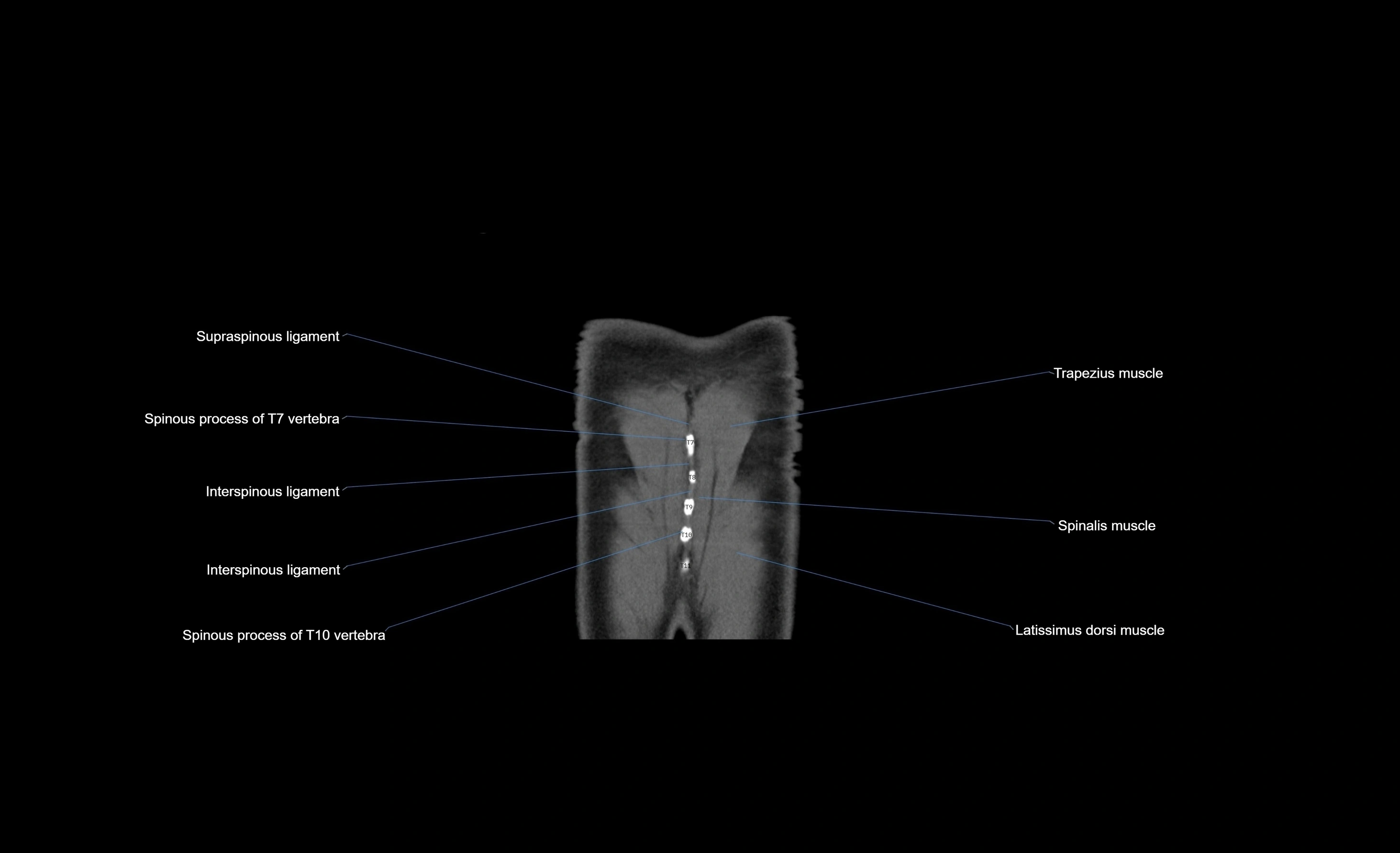 CT chest (thorax) soft tissue window labelled coronal cross sectional anatomy radiology image-00005.webp